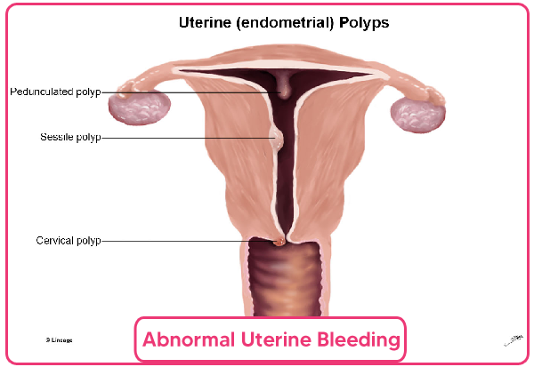 Abnormal Uterine Bleeding AUB