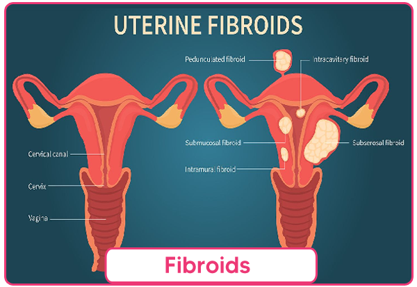 Fibroids