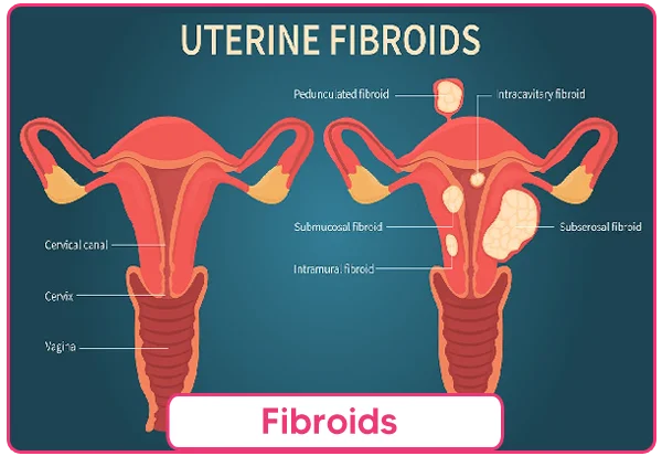 Fibroids