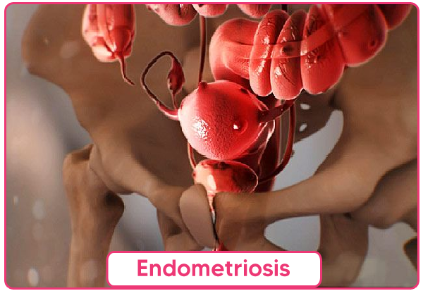 Endometriosis