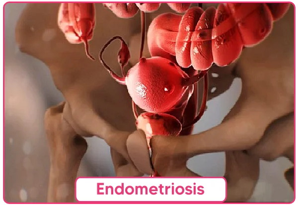 Endometriosis