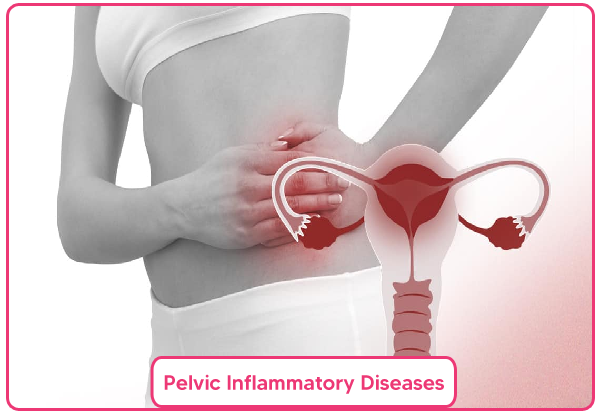 Pelvic Inflammatory Diseases PID