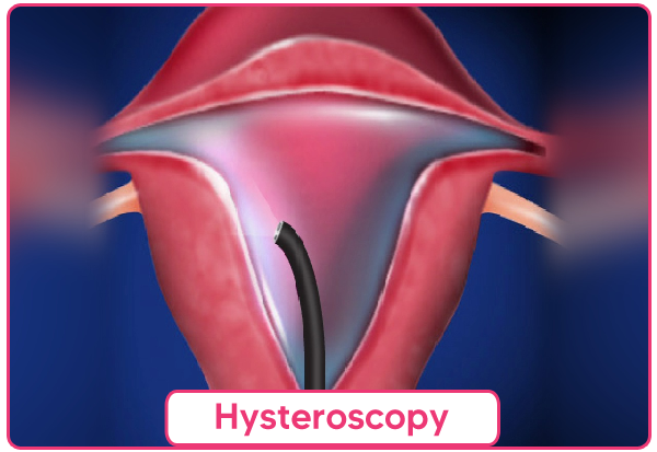 Hysteroscopy