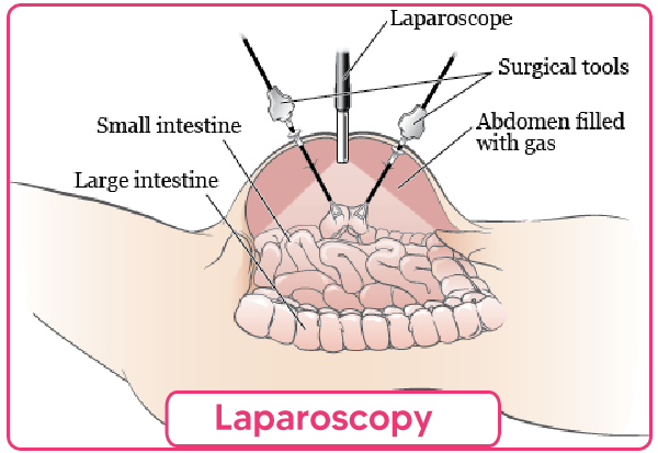 Laparoscopy