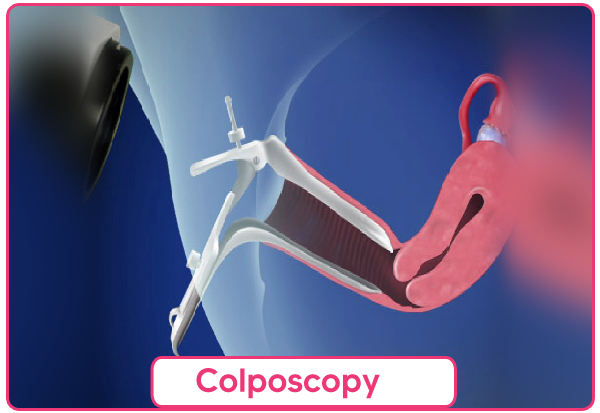 Colposcopy