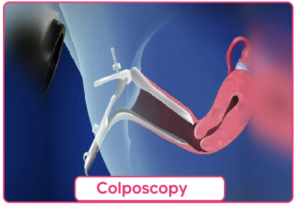 Colposcopy