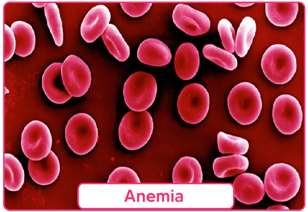 Anemia