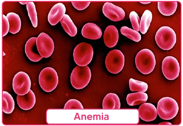 Anemia