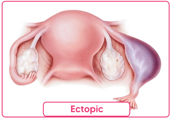 Ectopic