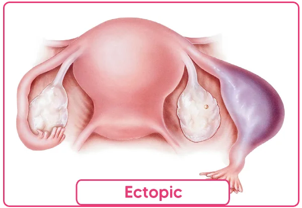Ectopic